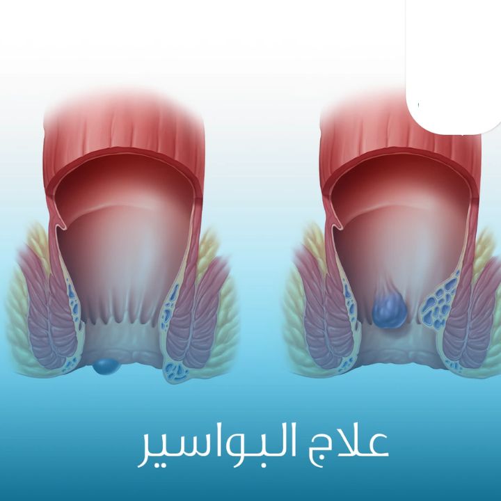 الحل الطبيعي النهائي للتخلص من البواسير الداخلية والخارجية