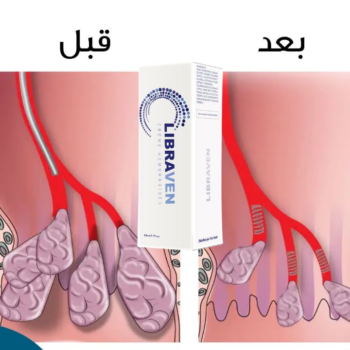 الحل الطبيعي النهائي للتخلص من البواسير الداخلية والخارجية