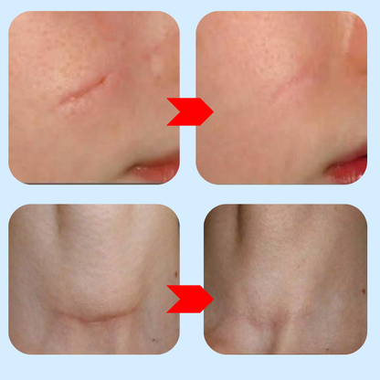 Crème Exacare لإزالة الندوب القديمة والجديدة، آثار الحبوب، وآثار الحروق