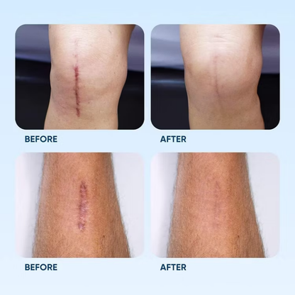 Crème Exacare لإزالة الندوب القديمة والجديدة، آثار الحبوب، وآثار الحروق