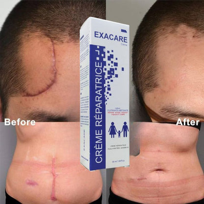 Crème Exacare لإزالة الندوب القديمة والجديدة، آثار الحبوب، وآثار الحروق