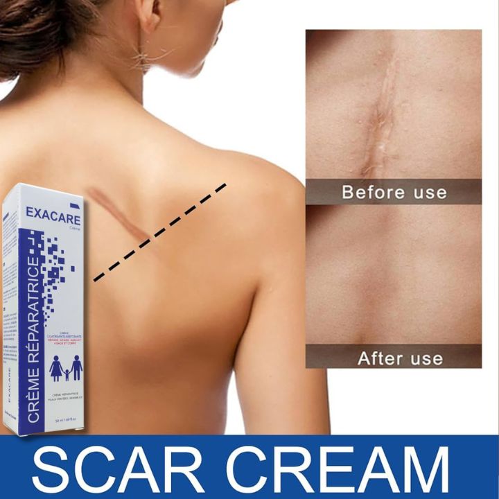 Crème Exacare لإزالة الندوب القديمة والجديدة، آثار الحبوب، وآثار الحروق