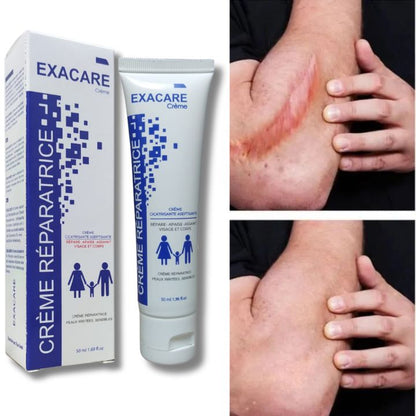 Crème Exacare لإزالة الندوب القديمة والجديدة، آثار الحبوب، وآثار الحروق